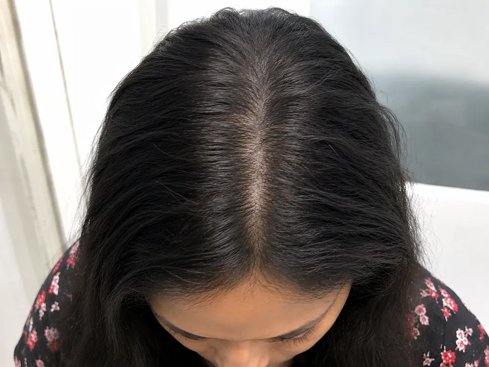 PRP Hair Therapy
